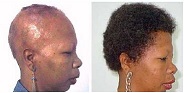 Tratamiento para la alopecia