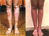Tratamiento contra el vitiligo